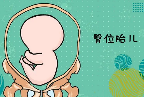 子宫发育异常造成臀位胎儿
