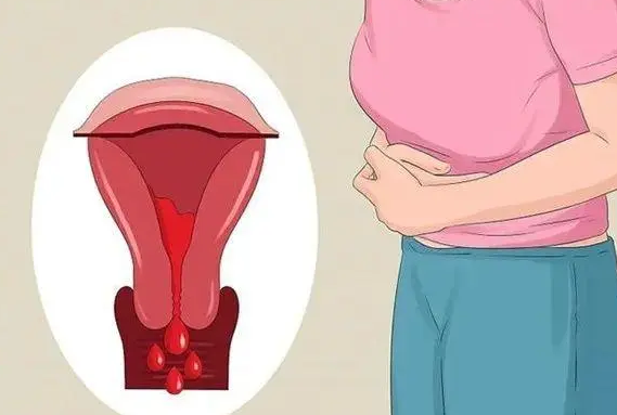 子宫腺肌症有多种治疗手段