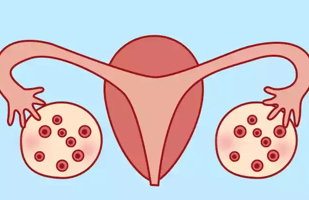 患有多囊卵巢综合症和输卵管堵塞的女性做几代试管好？