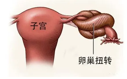 取卵后卵巢扭转怎么办？卵巢扭转的前兆！