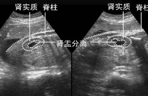双肾盂分离90%是男孩？判断性别靠它准确度更高