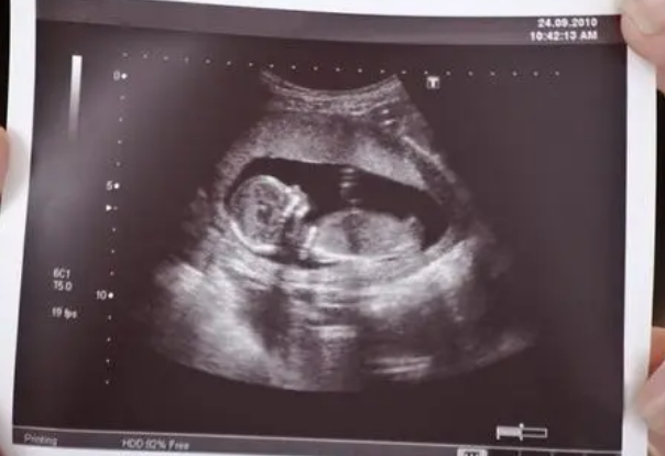 第3代试管婴儿要做nt检查是为了去医院建档吗？