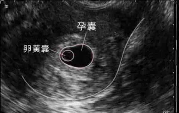 36岁女性有卵黄囊但孕中期胎停了最大的原因是什么？