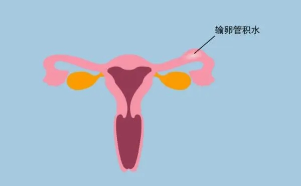 双侧输卵管有严重积水做试管前需要处理吗？