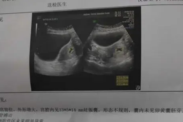 通过看孕囊形态来得知是男孩还是女孩的准确率有多少？