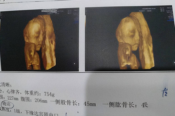 做四维检查会暴露胎儿性别