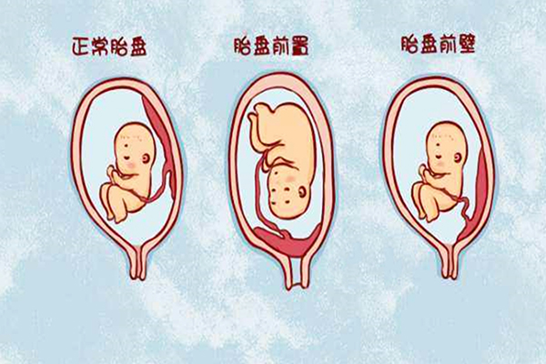 胎盘前壁属于正常现象