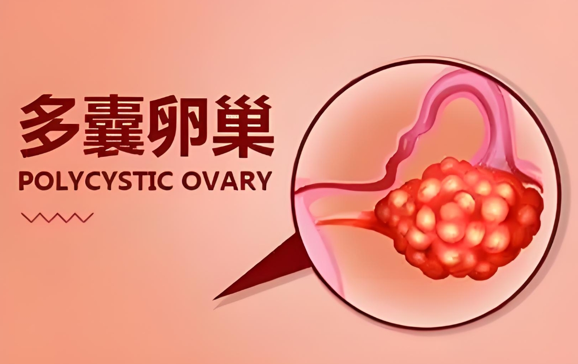 多囊卵巢患者应该如何提高受孕几率？