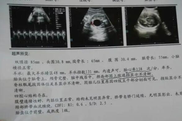 彩超单子如何3秒钟看出来是男孩还是女孩?