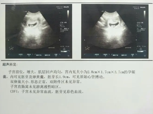 双肾未见明显分离并不一定是男孩
