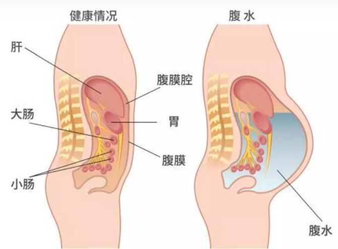 取卵后出现腹水有哪些症状？防腹水小指南了解一下！