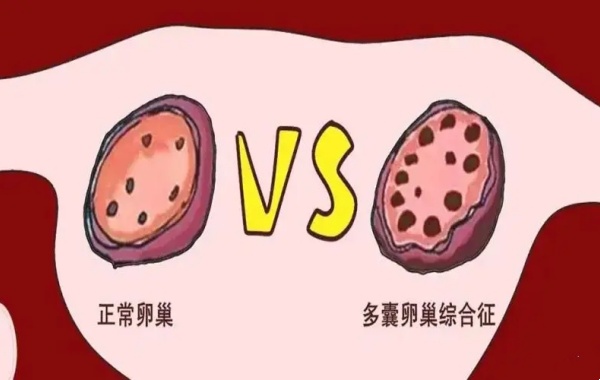 卵巢一侧有16个卵泡但月经正常是多囊吗？