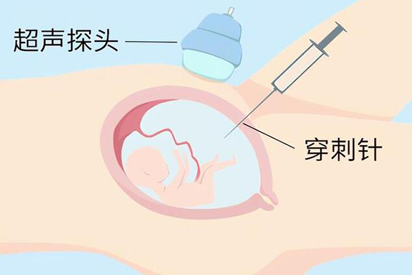 羊水穿刺费用高
