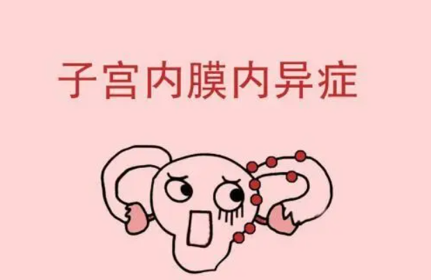 子宫内膜异位会导致不孕