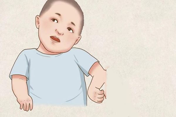 脑瘫儿头后仰是什么样子的，有照片吗?