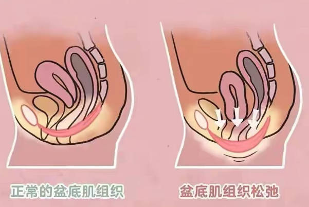 黄体酮具有促使妊娠子宫肌肉松弛的作用