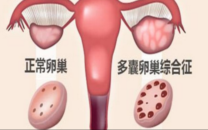中医为啥说患有多囊卵巢综合症的人容易生龙凤胎？