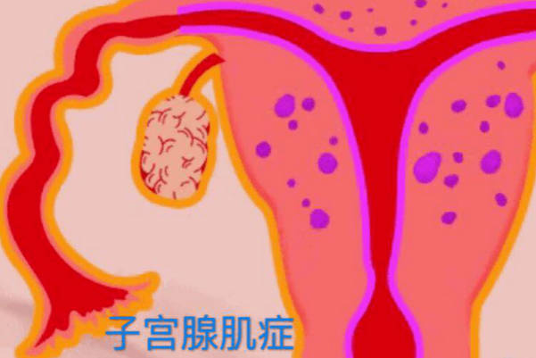 达菲林治疗子宫腺肌症有一定副作用