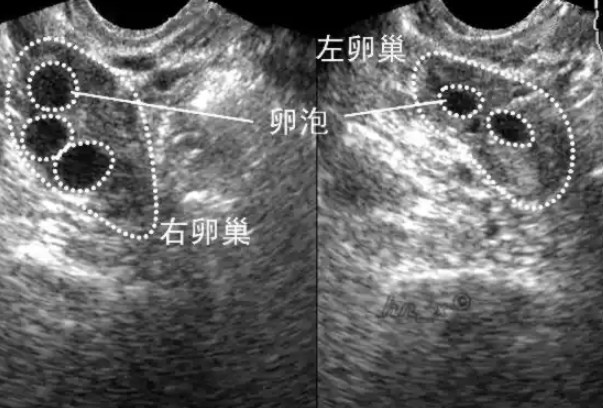 27岁女患者做试管促排后总共取卵才3个正常吗？