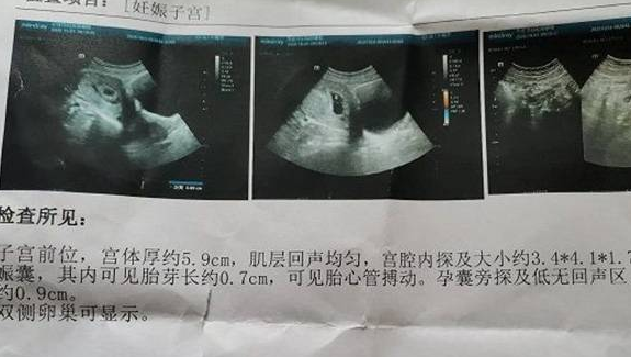 孕囊呈长条形生男孩几率大