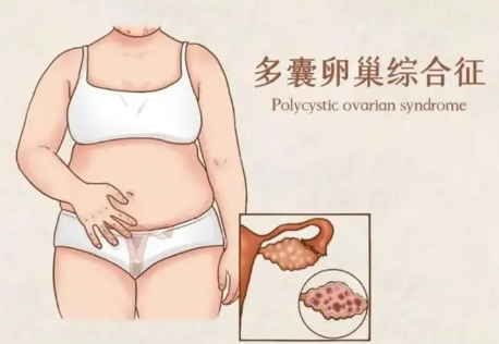 多囊患者吃药促排跟自然排卵的效果有什么区别