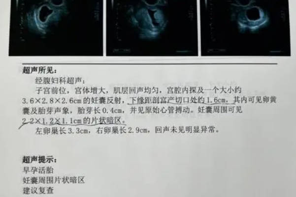 孕13周宫腔积液保胎成功率不高