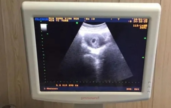 40天的孕囊图片可以看出男宝女宝吗？