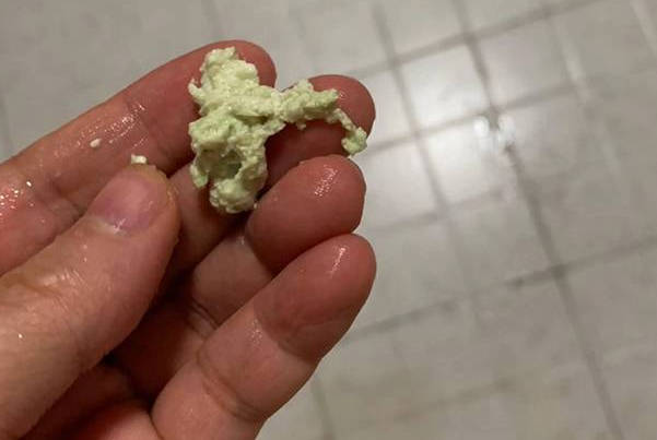 雪诺酮塞阴后变成绿色说明阴道有炎症