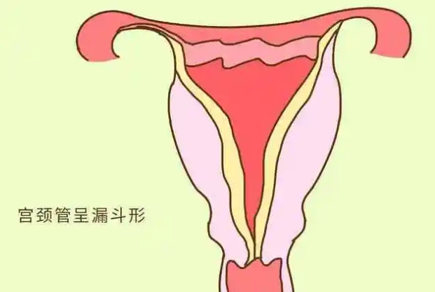 先天性宫颈短在怀孕期间居然长上去了怎么回事？