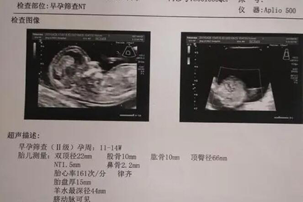 试管nt检查已过还要做羊水穿刺和无创dna吗?