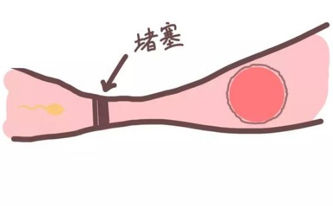 输卵管堵塞是女性不孕的常见原因，吃什么药能让输卵管通畅？