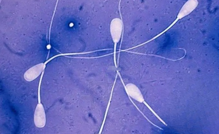 柬埔寨NRC三代试管成功案例：精子畸形率85%也能受孕