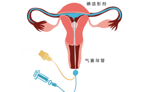输卵管造影可以检查女性输卵管是否通畅，输卵管造影后流血几天算正常？
