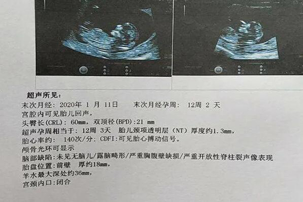 nt值偏高生男娃的几率大