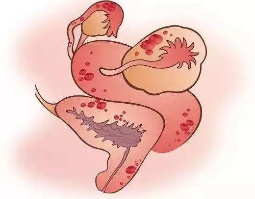 盆腔积液影响女性受孕，注意饮食身体会更健康快收藏