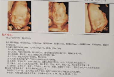 通过怀孕25周四维数据看男宝女宝99%都正确，是真的吗?