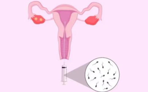 科普：人工授精和试管婴儿的区别