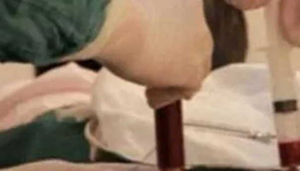 胎儿是否患病以羊穿结果为准