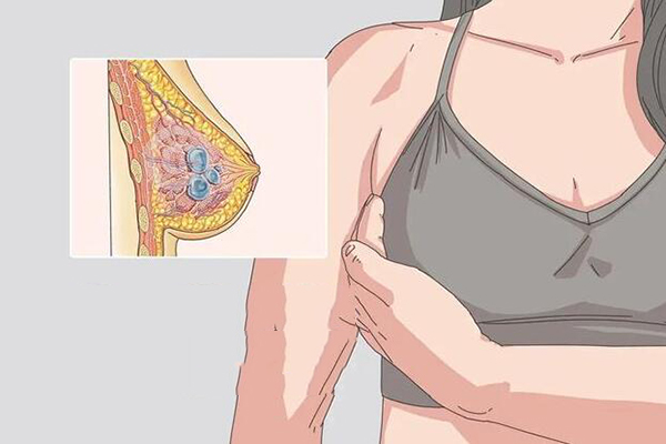 3类乳房囊肿影响做三代试管婴儿吗?