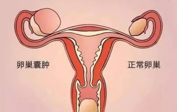35岁女性单侧良性卵巢囊肿做一代试管能成功吗？