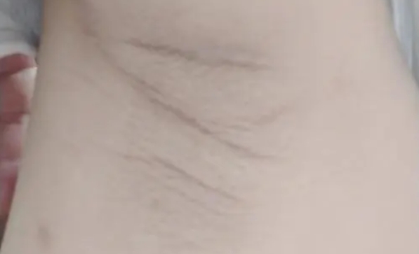 腋窝黑线看男女的准确率不高