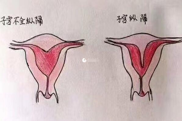 不完全纵隔子宫做试管有3个条件，宫内环境好可助孕