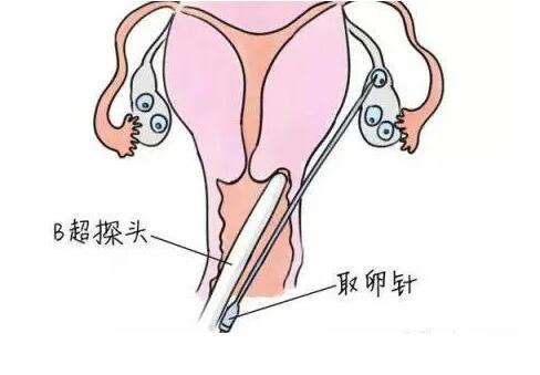 泰国试管婴儿费用中自然周期取卵花费？为您讲讲取卵费用那些事！