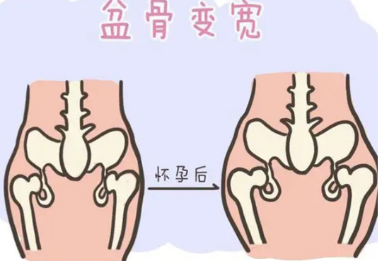 产妇还是有必要做盆骨修复