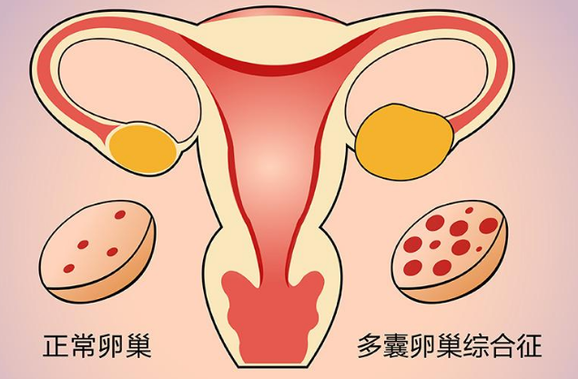 同时患有多囊卵巢和输卵管堵塞做几代试管婴儿成功率较高？